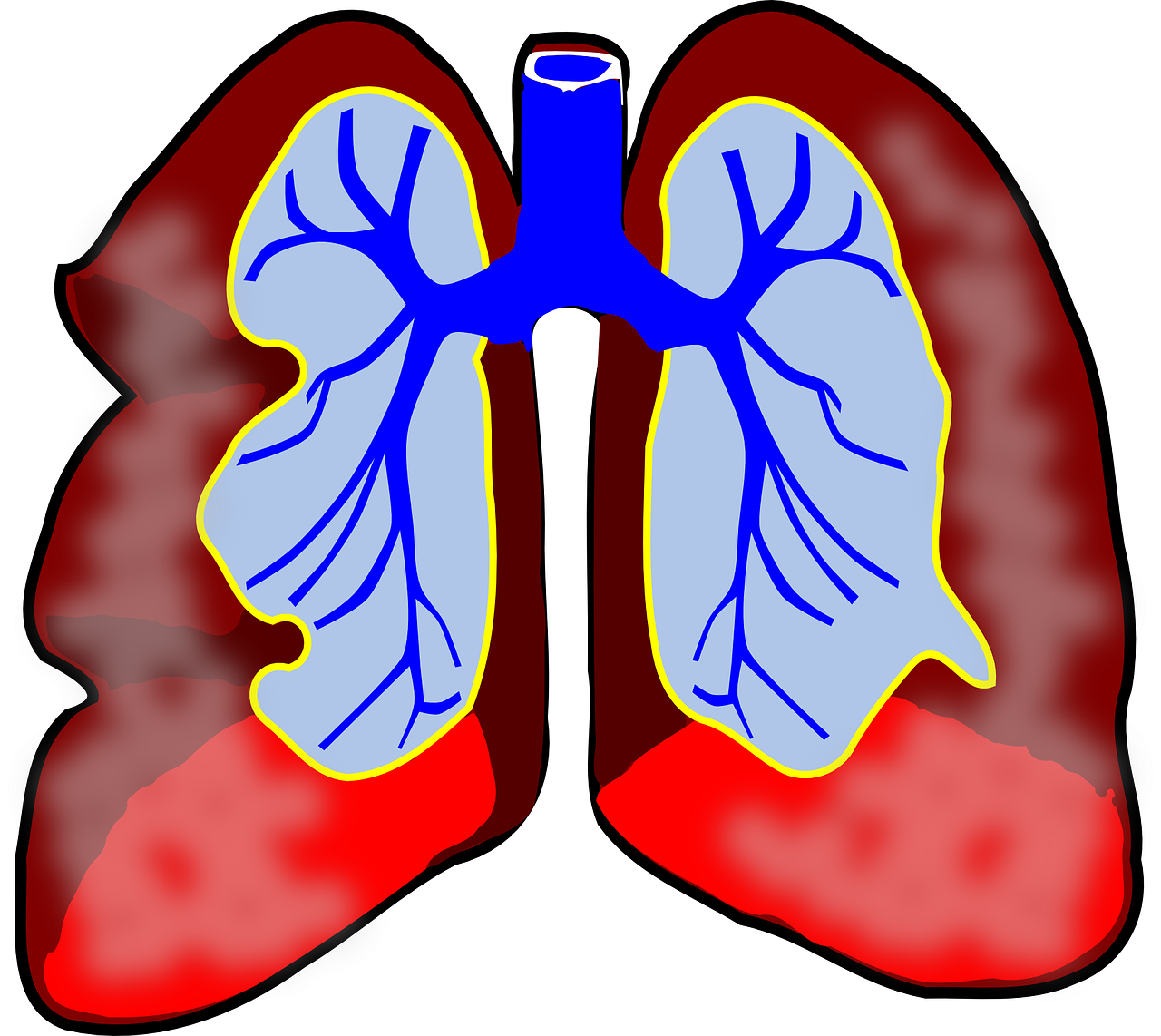 A tüdő megtisztítása a dohányzásról való leszokás, Tüdő tisztítása dohányosoknak - Sószoba Pécs